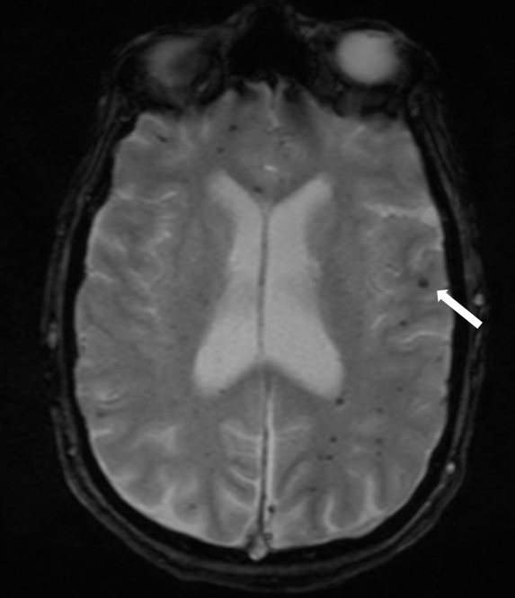 A Clinical Update of Intracerebral Hemorrhage | NeurologyLive